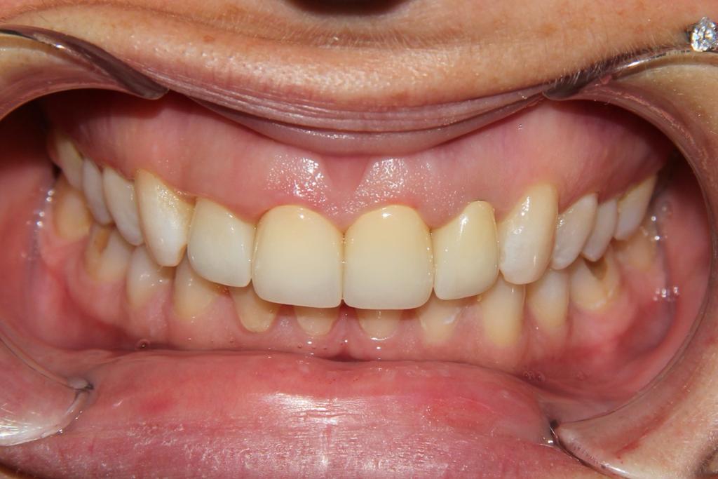 Протезирование фронтальной группы зубов с помощью цельноциркониевых коронок
